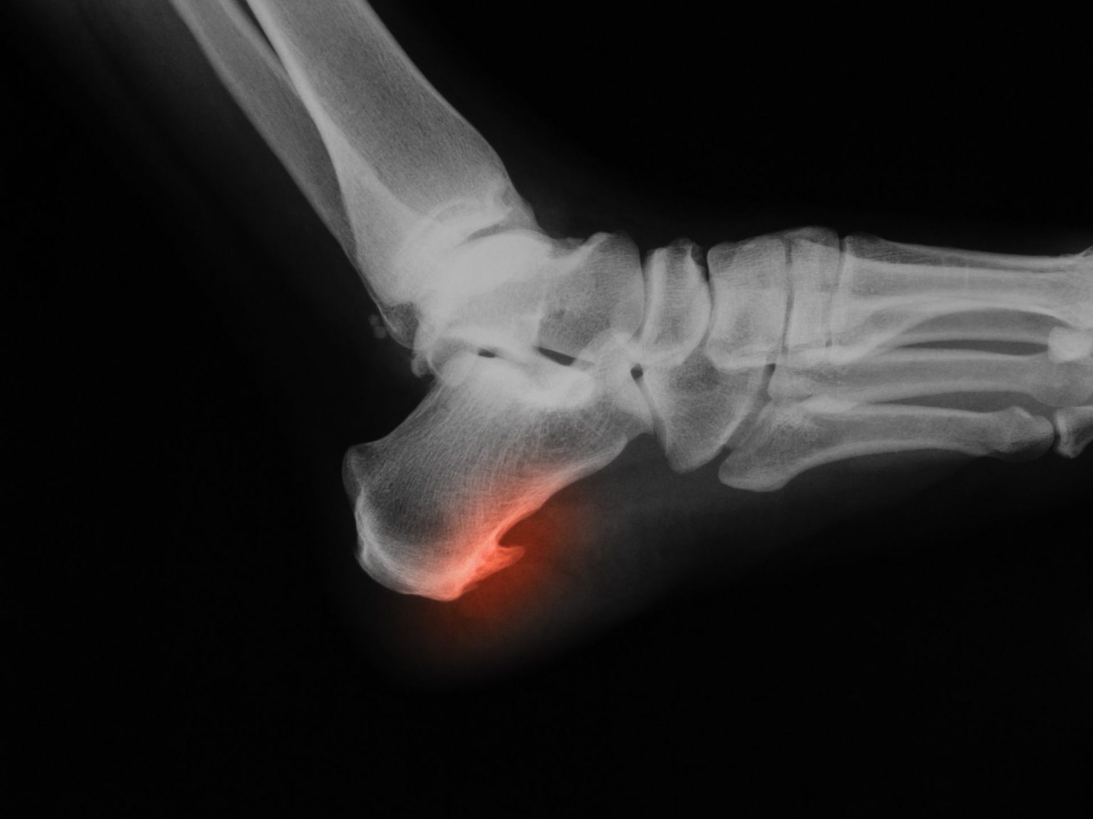 Spina Calcaneare Onde D Urto Spina Calcaneare Onde D Urto